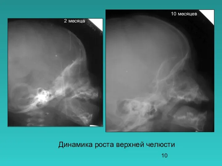 Динамика роста верхней челюсти 2 месяца 10 месяцев