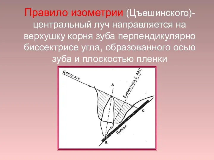 Правило изометрии (Цъешинского)- центральный луч направляется на верхушку корня зуба перпендикулярно