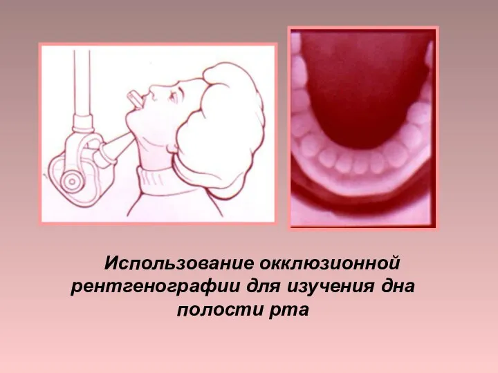 Использование окклюзионной рентгенографии для изучения дна полости рта