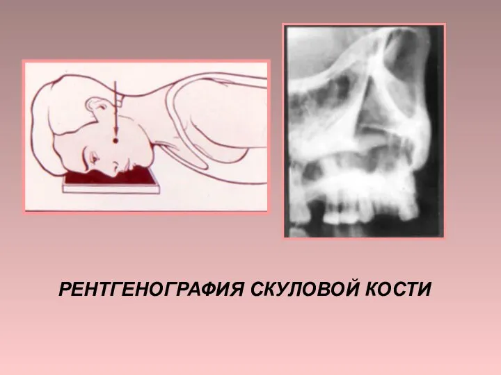 РЕНТГЕНОГРАФИЯ СКУЛОВОЙ КОСТИ