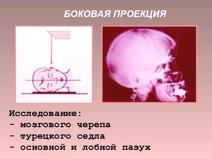 БОКОВАЯ ПРОЕКЦИЯ Исследование: - мозгового черепа - турецкого седла - основной и лобной пазух