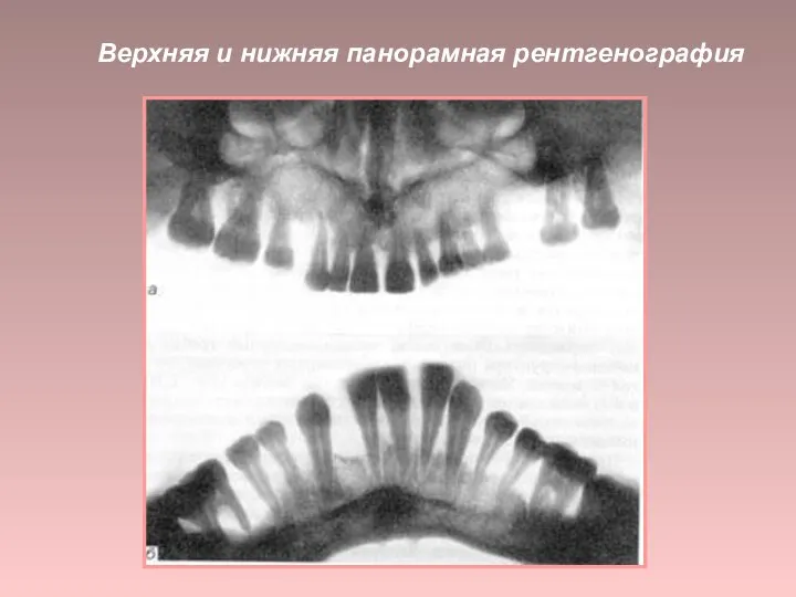 Верхняя и нижняя панорамная рентгенография