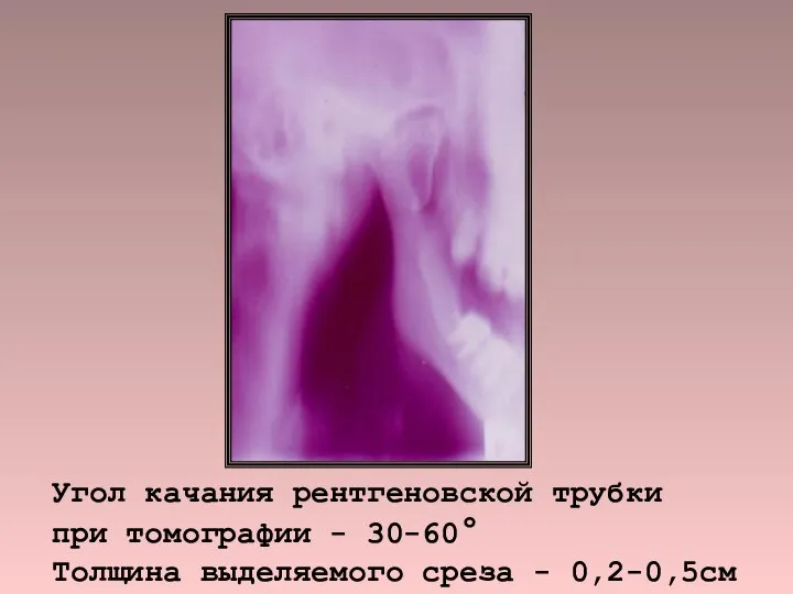 Угол качания рентгеновской трубки при томографии - 30-60° Толщина выделяемого среза - 0,2-0,5см