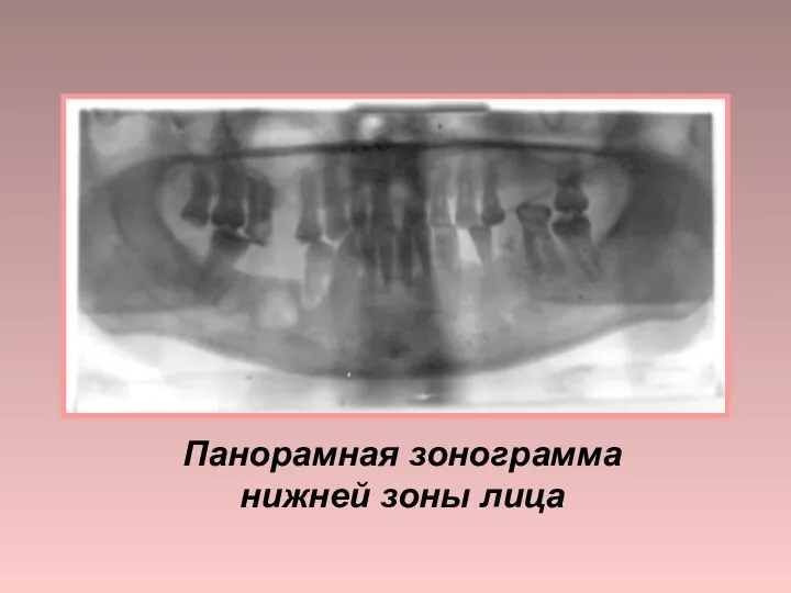 Панорамная зонограмма нижней зоны лица