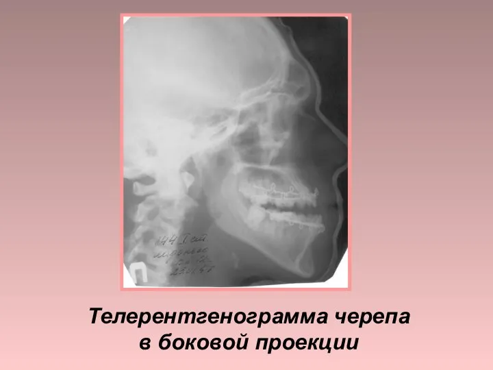 Телерентгенограмма черепа в боковой проекции