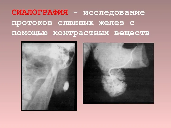 СИАЛОГРАФИЯ - исследование протоков слюнных желез с помощью контрастных веществ