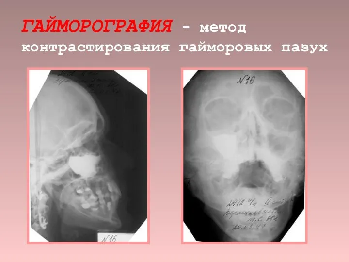 ГАЙМОРОГРАФИЯ - метод контрастирования гайморовых пазух