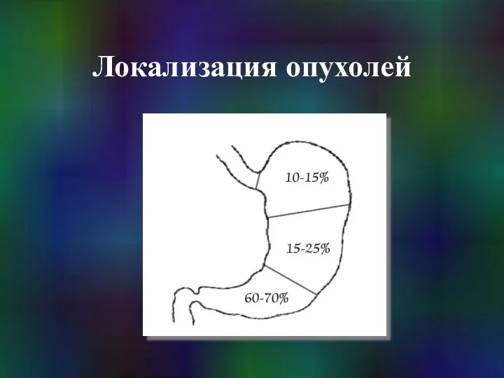 Локализация опухолей