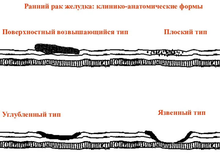 Ранний рак желудка: клинико-анатомические формы Поверхностный возвышающийся тип Плоский тип Углубленный тип Язвенный тип