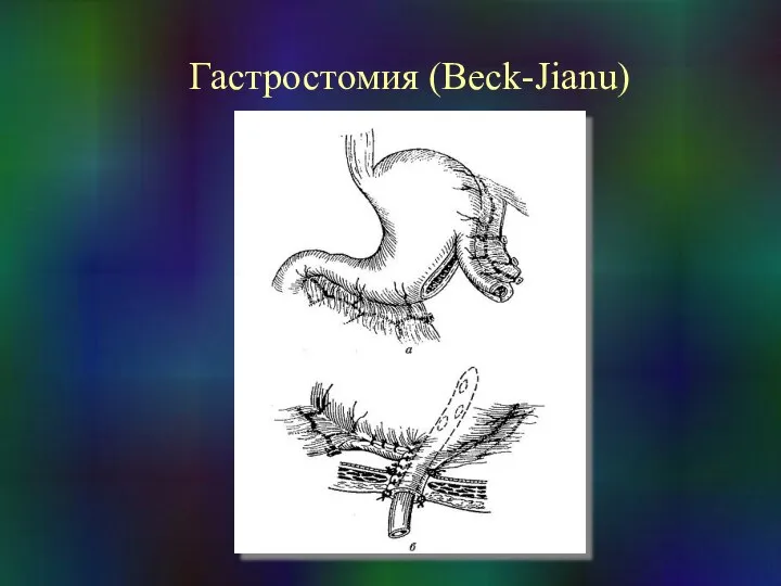 Гастростомия (Beck-Jianu)