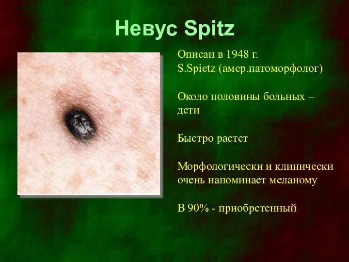 Невус Spitz Описан в 1948 г. S.Spietz (амер.патоморфолог) Около половины больных