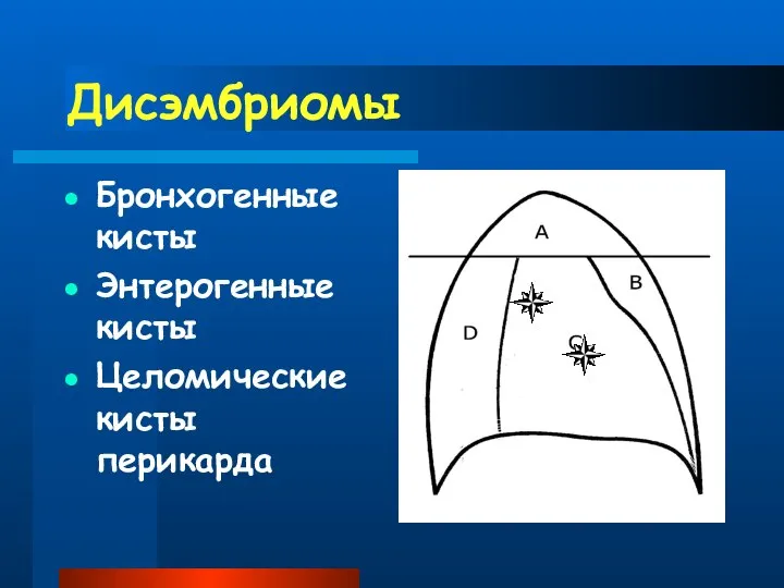 Дисэмбриомы Бронхогенные кисты Энтерогенные кисты Целомические кисты перикарда