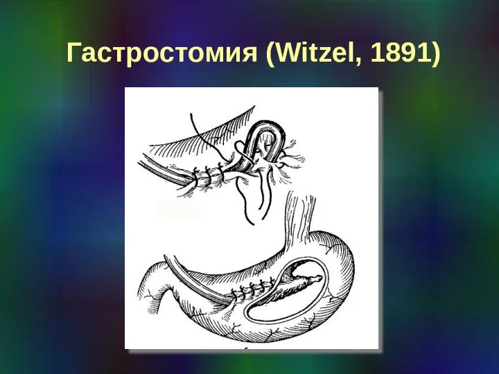 Гастростомия (Witzel, 1891)