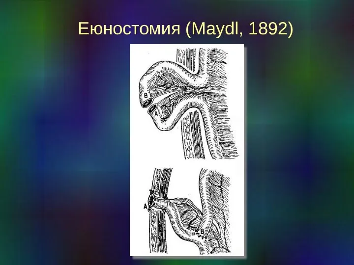 Еюностомия (Maydl, 1892)