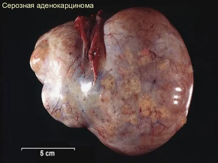 Серозная аденокарцинома