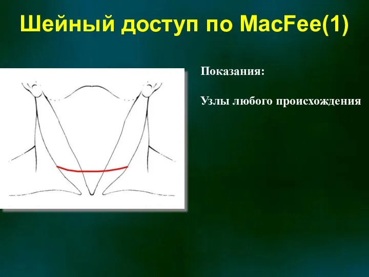 Шейный доступ по MacFee(1) Показания: Узлы любого происхождения