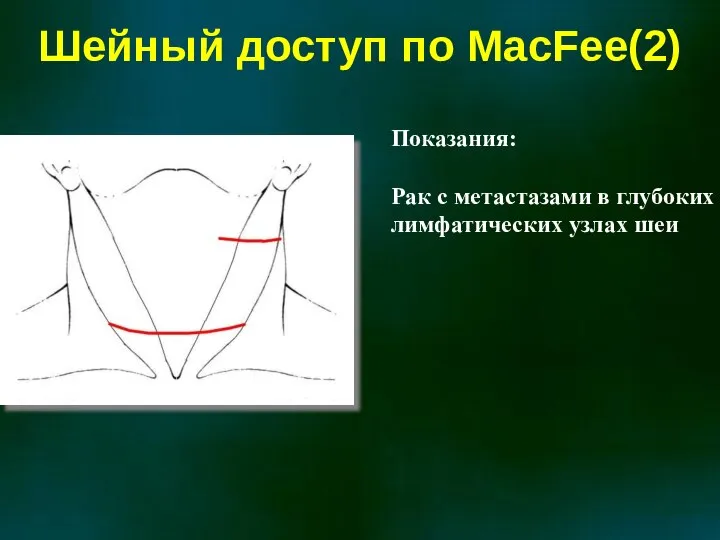 Шейный доступ по MacFee(2) Показания: Рак с метастазами в глубоких лимфатических узлах шеи