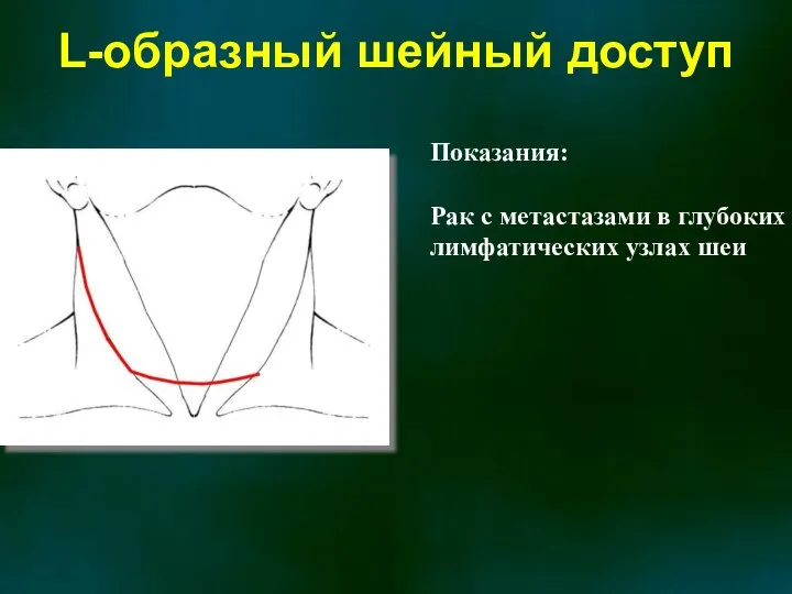 L-образный шейный доступ Показания: Рак с метастазами в глубоких лимфатических узлах шеи