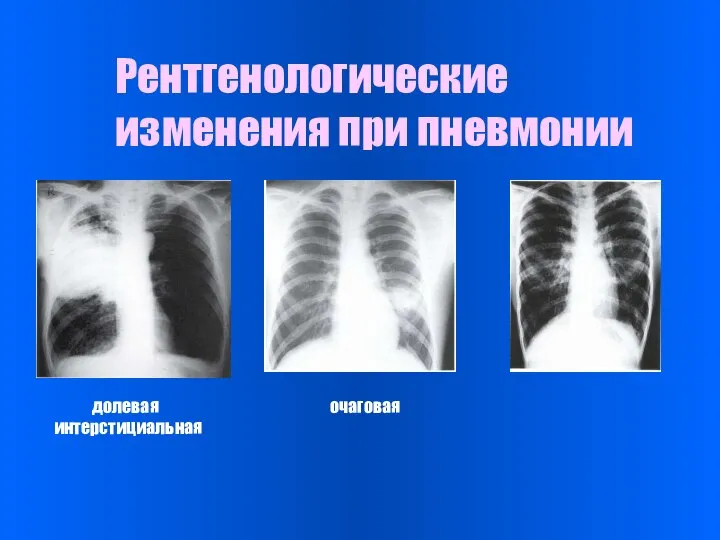 Рентгенологические изменения при пневмонии долевая очаговая интерстициальная