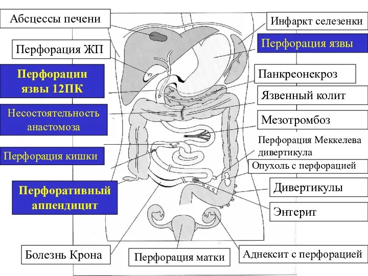 Инфаркт селезенки Перфорация язвы Панкреонекроз Язвенный колит Мезотромбоз Перфорация Меккелева дивертикула