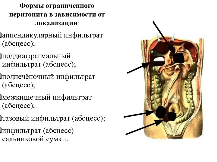 Формы ограниченного перитонита в зависимости от локализации: аппендикулярный инфильтрат (абсцесс); поддиафрагмальный