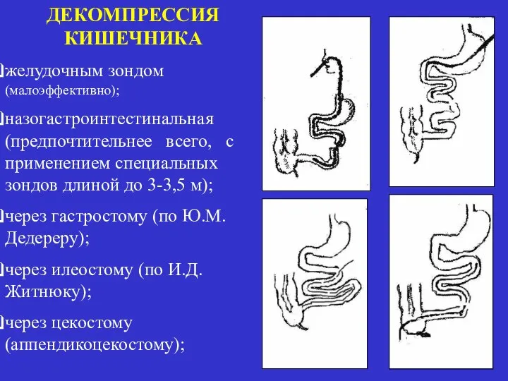 ДЕКОМПРЕССИЯ КИШЕЧНИКА желудочным зондом (малоэффективно); назогастроинтестинальная (предпочтительнее всего, с применением специальных