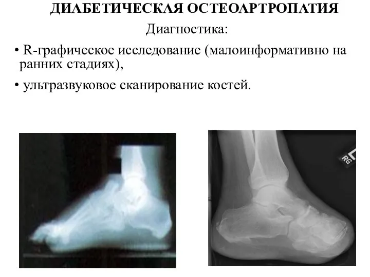 ДИАБЕТИЧЕСКАЯ ОСТЕОАРТРОПАТИЯ Диагностика: R-графическое исследование (малоинформативно на ранних стадиях), ультразвуковое сканирование костей.