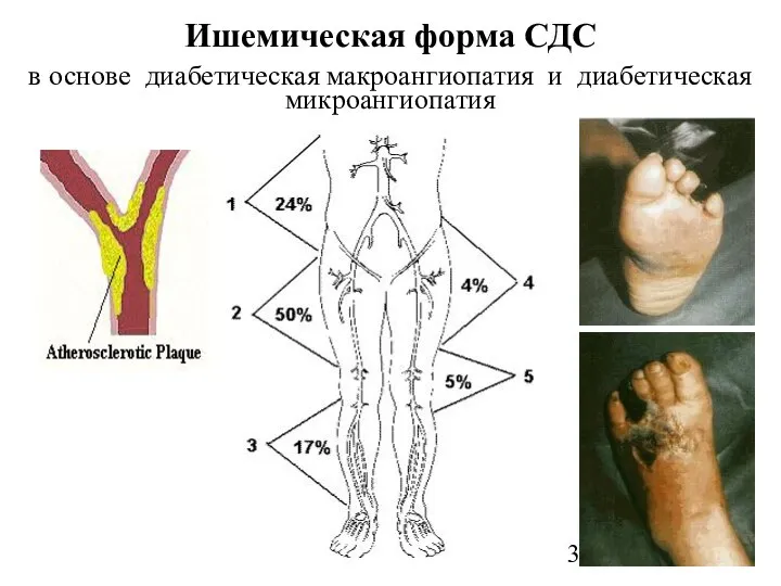 Ишемическая форма СДС в основе диабетическая макроангиопатия и диабетическая микроангиопатия