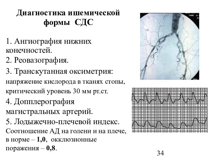 Диагностика ишемической формы СДС 1. Ангиография нижних конечностей. 2. Реовазография. 3.