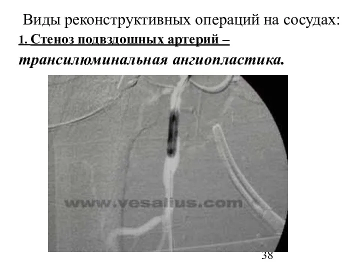 Виды реконструктивных операций на сосудах: 1. Стеноз подвздошных артерий – трансилюминальная ангиопластика.
