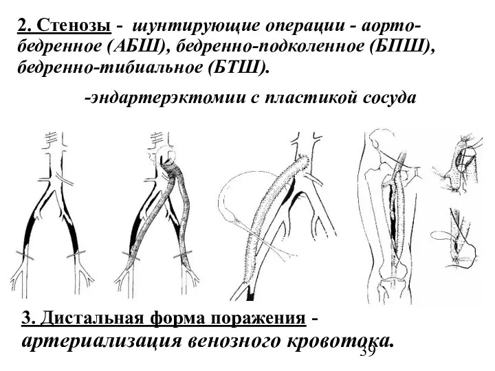 2. Стенозы - шунтирующие операции - аорто-бедренное (АБШ), бедренно-подколенное (БПШ), бедренно-тибиальное