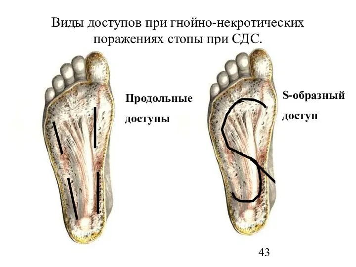 Виды доступов при гнойно-некротических поражениях стопы при СДС. Продольные доступы S-образный доступ