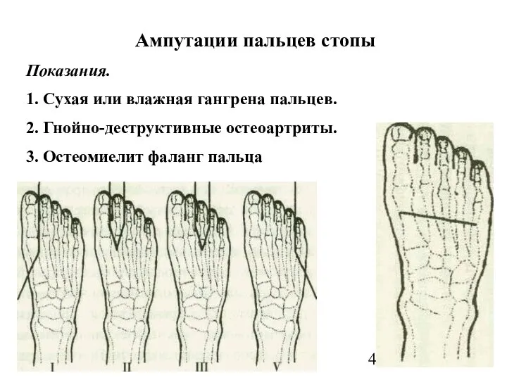 Ампутации пальцев стопы Показания. 1. Сухая или влажная гангрена пальцев. 2.