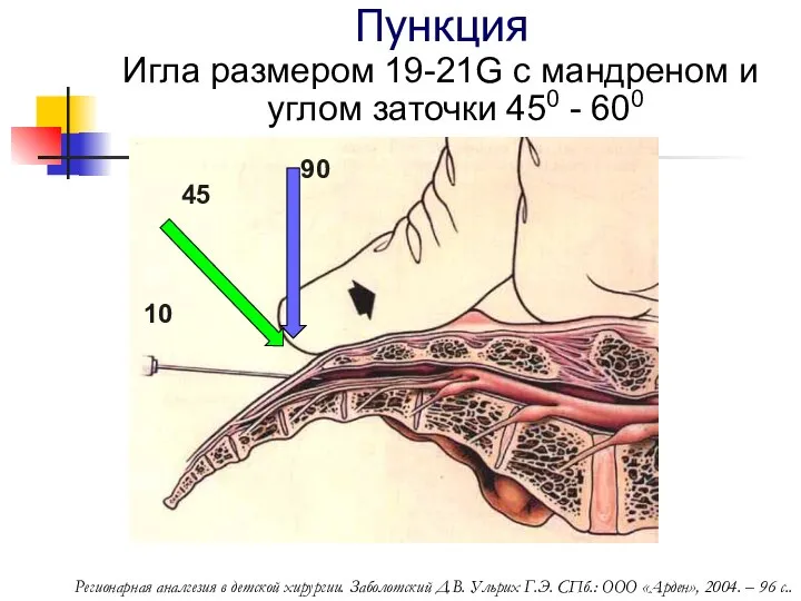 Пункция 90 45 10 Игла размером 19-21G с мандреном и углом