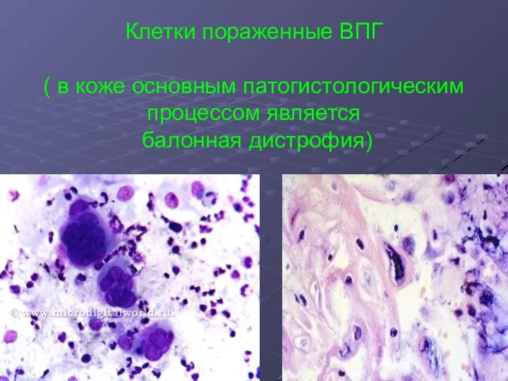 Клетки пораженные ВПГ ( в коже основным патогистологическим процессом является балонная дистрофия)