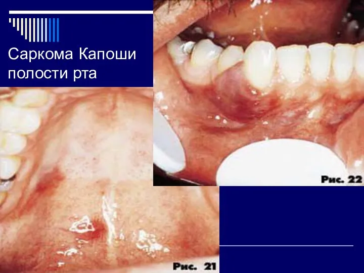 Саркома Капоши полости рта