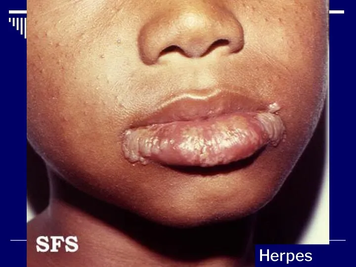 Herpes simplex