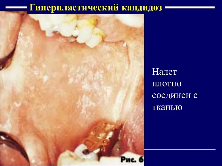 Налет плотно соединен с тканью Гиперпластический кандидоз