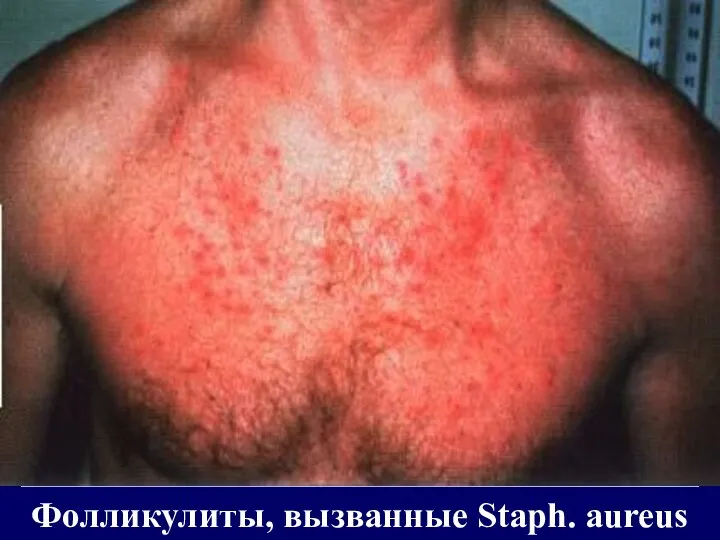 Фолликулиты, вызванные Staph. aureus