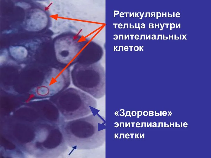 Ретикулярные тельца внутри эпителиальных клеток «Здоровые» эпителиальные клетки