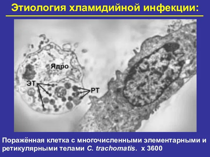 Этиология хламидийной инфекции: Поражённая клетка с многочисленными элементарными и ретикулярными телами C. trachomatis. х 3600