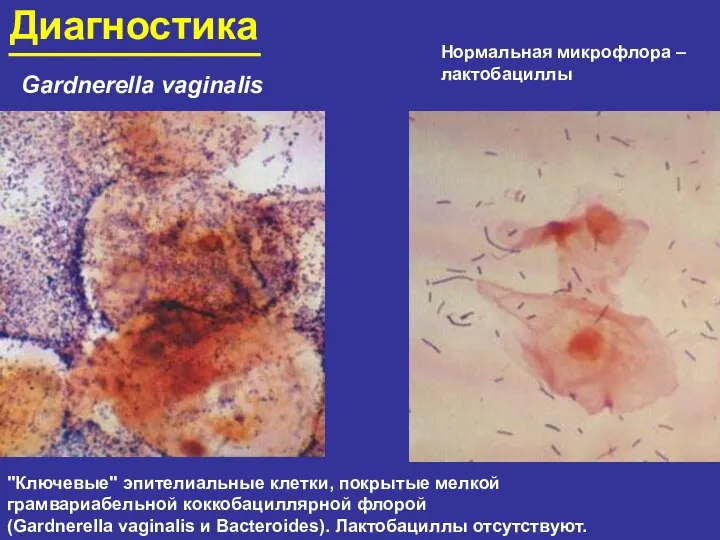 Диагностика Gardnerella vaginalis "Ключевые" эпителиальные клетки, покрытые мелкой грамвариабельной коккобациллярной флорой