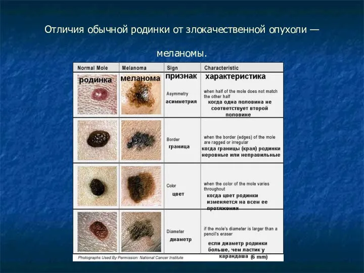 Отличия обычной родинки от злокачественной опухоли — меланомы.