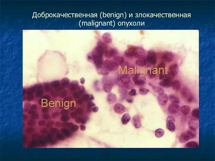 Доброкачественная (benign) и злокачественная (malignant) опухоли