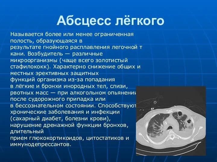 Абсцесс лёгкого Называется более или менее ограниченная полость, образующаяся в результате