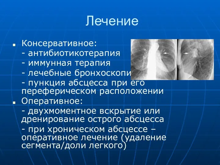 Лечение Консервативное: - антибиотикотерапия - иммунная терапия - лечебные бронхоскопии -