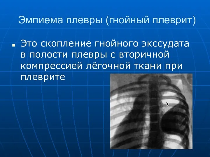 Эмпиема плевры (гнойный плеврит) Это скопление гнойного экссудата в полости плевры