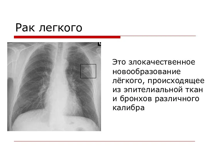 Рак легкого Это злокачественное новообразование лёгкого, происходящее из эпителиальной ткани бронхов различного калибра