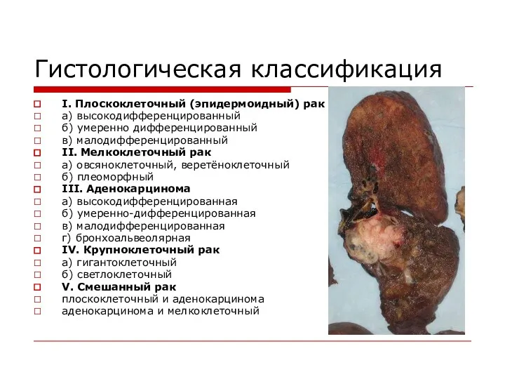 Гистологическая классификация I. Плоскоклеточный (эпидермоидный) рак а) высокодифференцированный б) умеренно дифференцированный