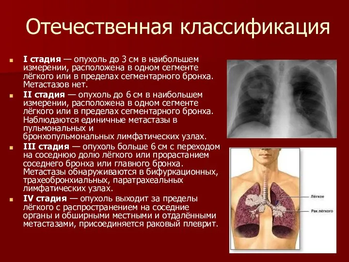 Отечественная классификация I стадия — опухоль до 3 см в наибольшем